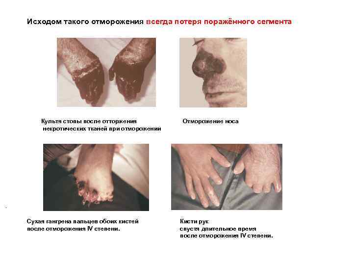 Исходом такого отморожения всегда потеря поражённого сегмента . Культя стопы после отторжения некротических тканей