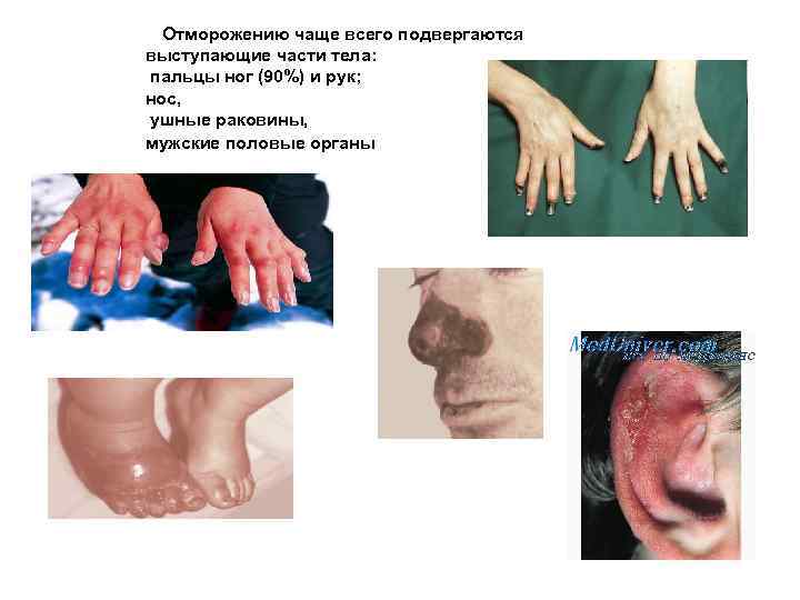  Отморожению чаще всего подвергаются выступающие части тела: пальцы ног (90%) и рук; нос,