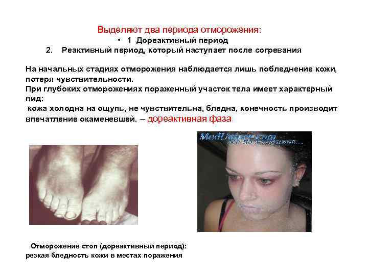  Выделяют два периода отморожения: • 1 Дореактивный период 2. Реактивный период, который наступает