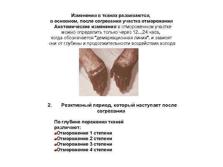 Изменения в тканях развиваются, в основном, после согревания участка отморожения Анатомические изменения в отмороженном