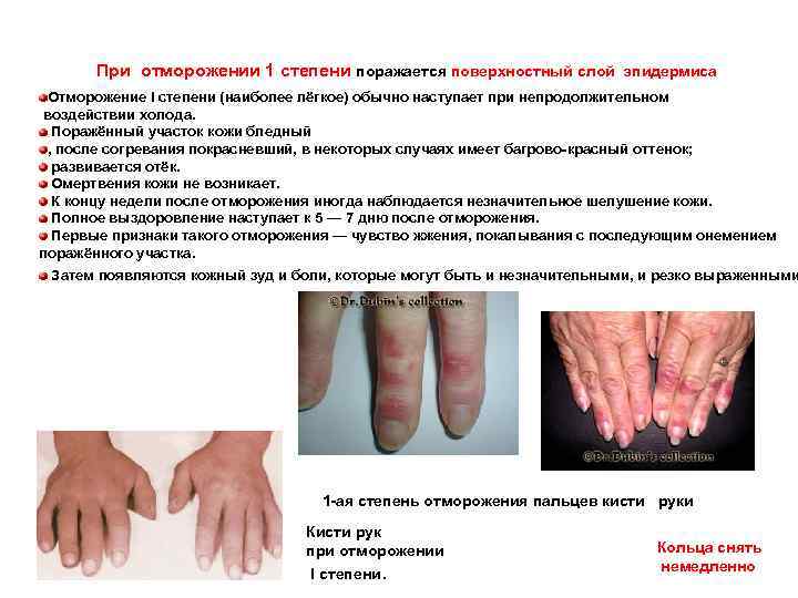  При отморожении 1 степени поражается поверхностный слой эпидермиса Отморожение I степени (наиболее лёгкое)