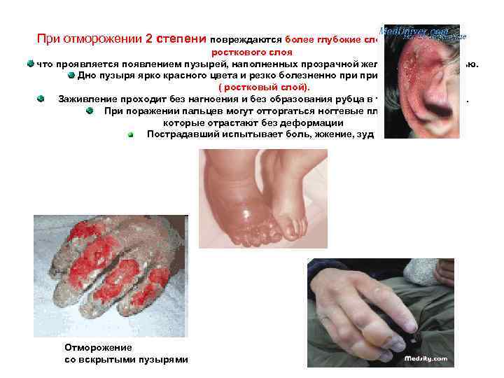 При отморожении 2 степени повреждаются более глубокие слои эпидермиса до росткового слоя что проявляется