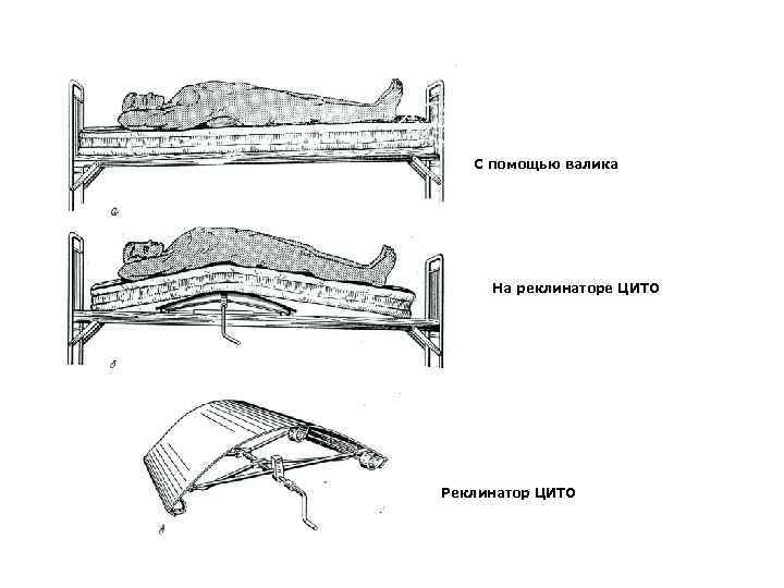 С помощью валика На реклинаторе ЦИТО Реклинатор ЦИТО 