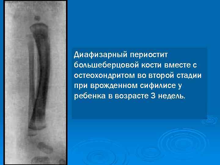 Диафизарный периостит большеберцовой кости вместе с остеохондритом во второй стадии при врожденном сифилисе у