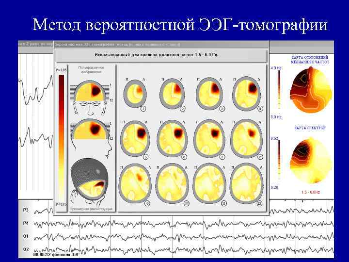 Метод вероятностной ЭЭГ-томографии 