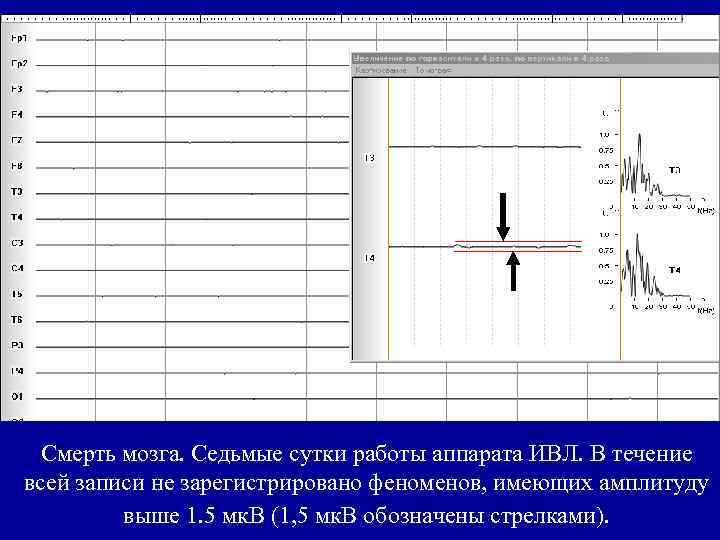 Смерть мозга. Cедьмые сутки работы аппарата ИВЛ. В течение всей записи не зарегистрировано феноменов,