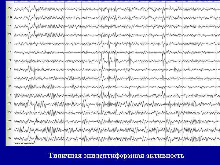 Типичная эпилептиформная активность 