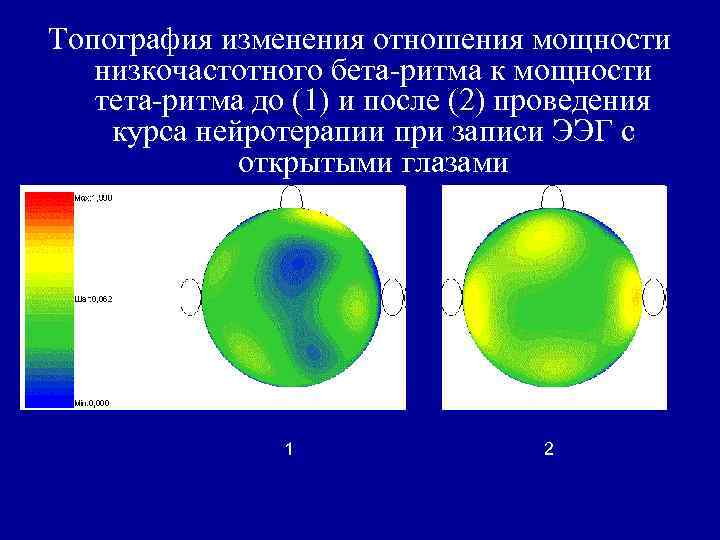 Топография изменения отношения мощности низкочастотного бета-ритма к мощности тета-ритма до (1) и после (2)