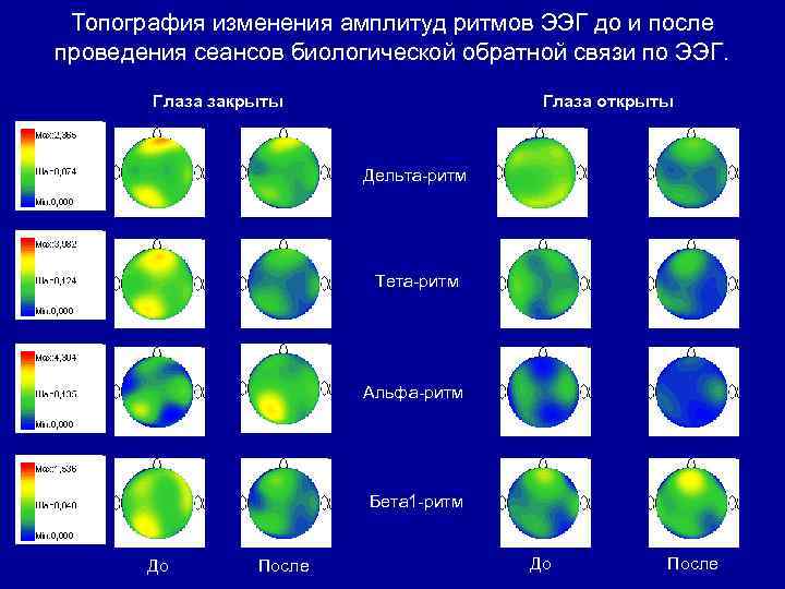 Топография изменения амплитуд ритмов ЭЭГ до и после проведения сеансов биологической обратной связи по