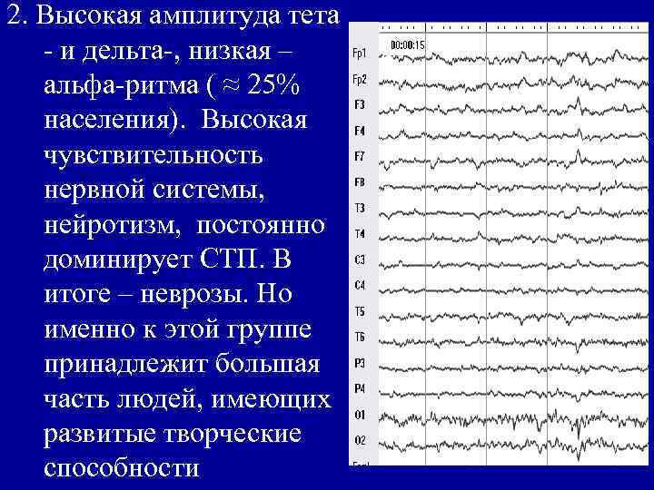 2. Высокая амплитуда тета - и дельта-, низкая – альфа-ритма ( ≈ 25% населения).
