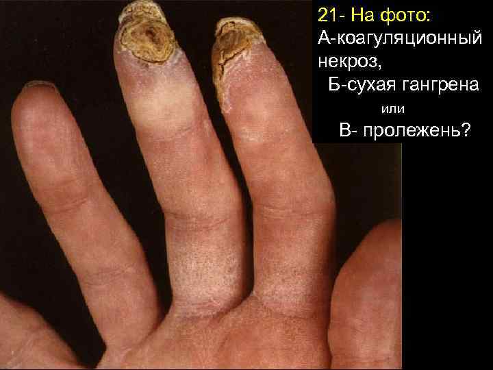 21 - На фото: А-коагуляционный некроз, Б-сухая гангрена или В- пролежень? 
