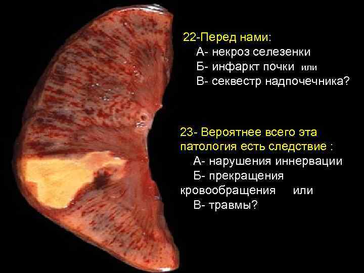 22 -Перед нами: А- некроз селезенки Б- инфаркт почки или В- секвестр надпочечника? 23