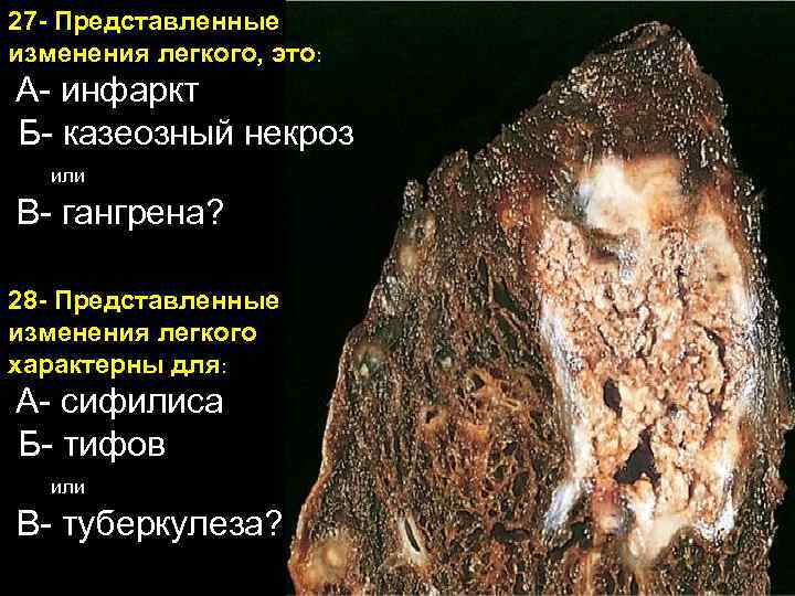 27 - Представленные изменения легкого, это: А- инфаркт Б- казеозный некроз или В- гангрена?