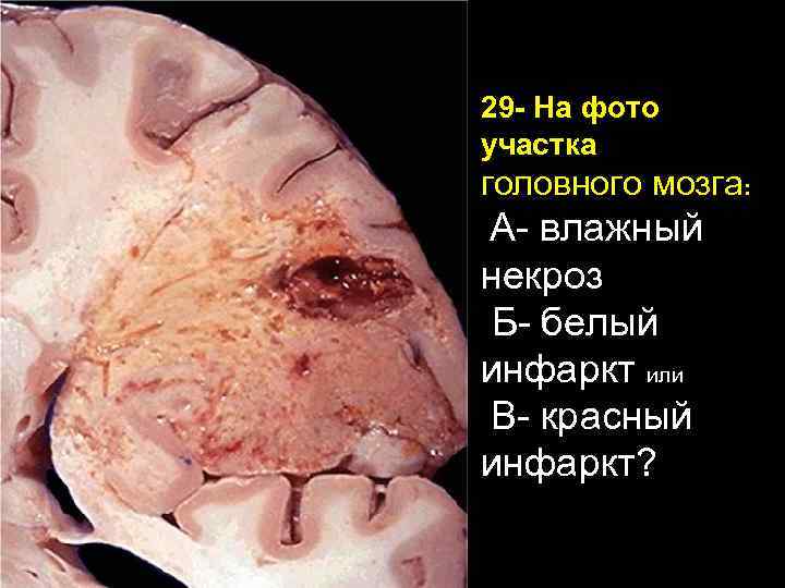 29 - На фото участка головного мозга: А- влажный некроз Б- белый инфаркт или