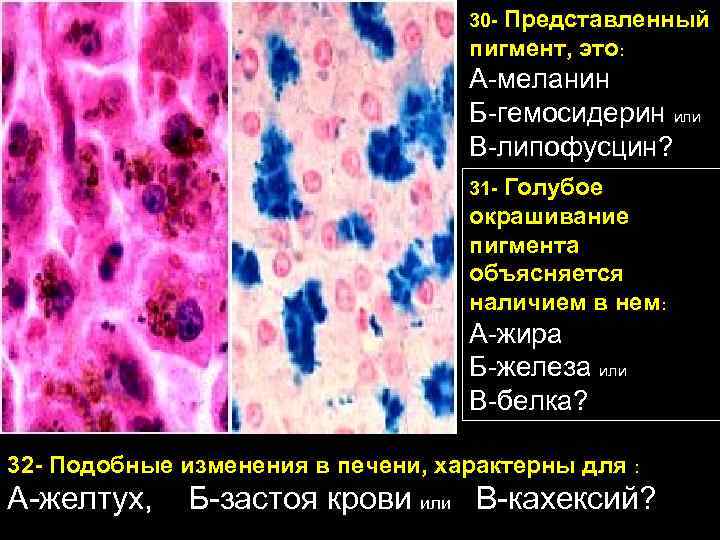 30 - Представленный пигмент, это: А-меланин Б-гемосидерин или В-липофусцин? 31 - Голубое окрашивание пигмента