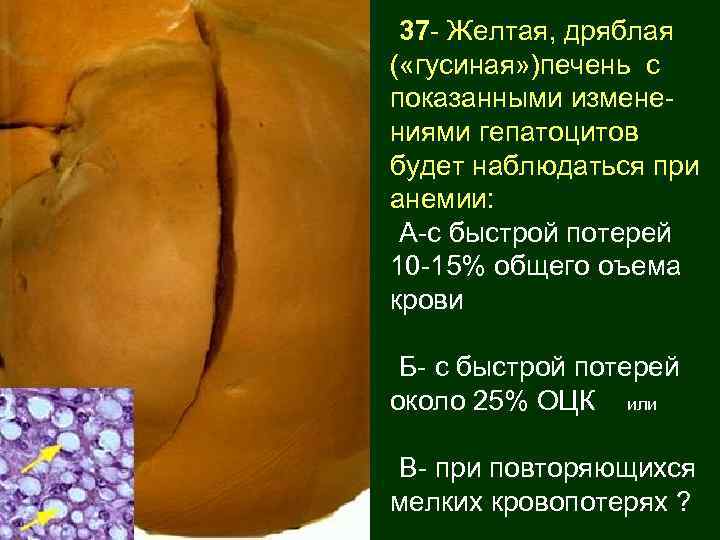 37 - Желтая, дряблая ( «гусиная» )печень с показанными изменениями гепатоцитов будет наблюдаться при