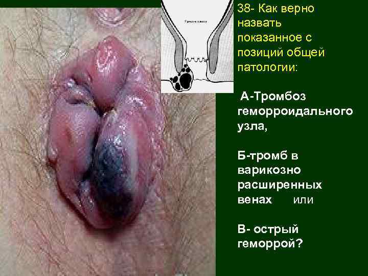 38 - Как верно назвать показанное с позиций общей патологии: А-Тромбоз геморроидального узла, Б-тромб