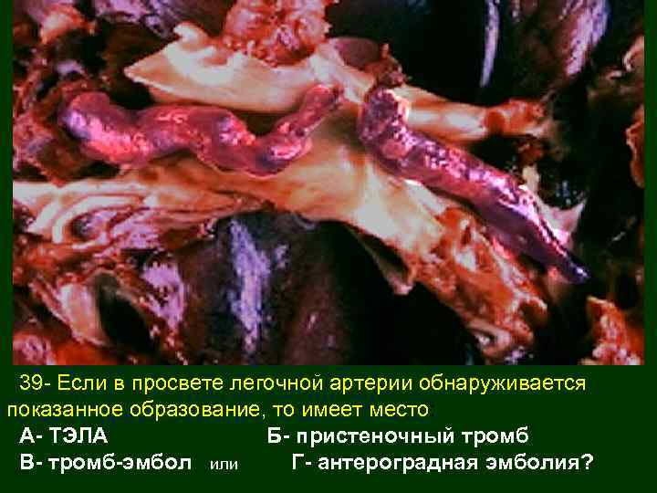 39 - Если в просвете легочной артерии обнаруживается показанное образование, то имеет место: А-