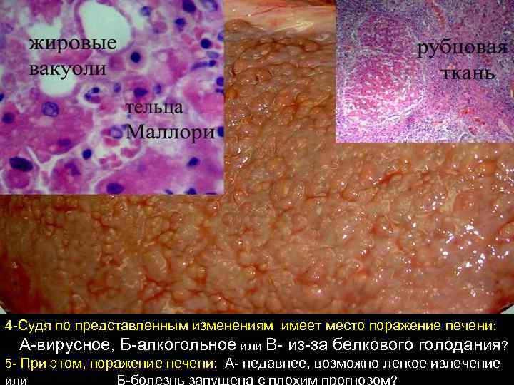 4 -Судя по представленным изменениям имеет место поражение печени: А-вирусное, Б-алкогольное или В- из-за