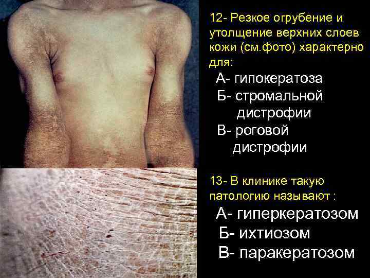 12 - Резкое огрубение и утолщение верхних слоев кожи (см. фото) характерно для: А-
