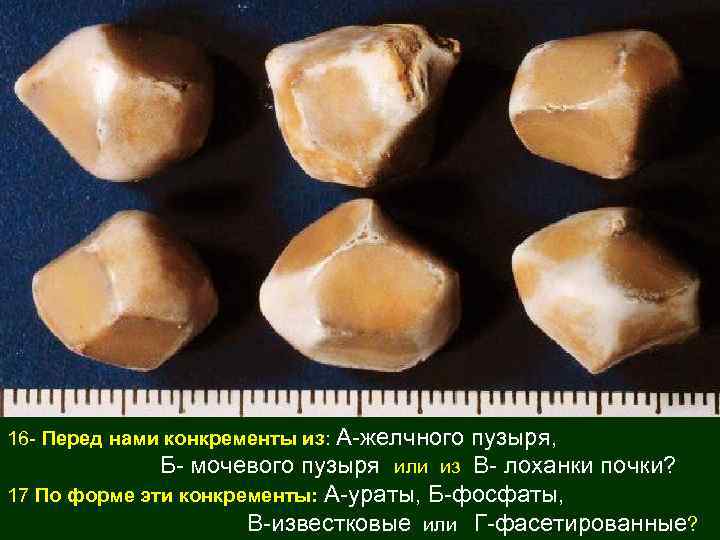 16 - Перед нами конкременты из: А-желчного пузыря, Б- мочевого пузыря или из В-
