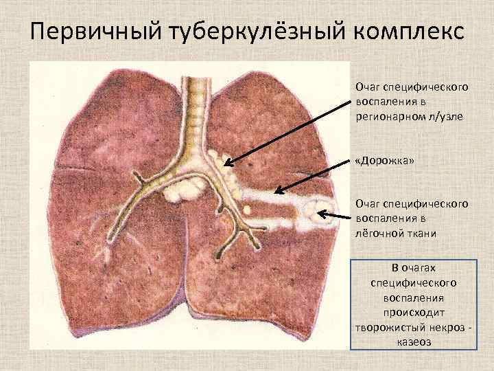 Первичный туберкулёзный комплекс Очаг специфического воспаления в регионарном л/узле «Дорожка» Очаг специфического воспаления в