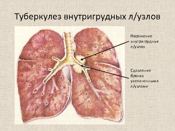 Туберкулез внутригрудных л/узлов Поражение внутригрудных л/узлов Сдавление бронха увеличенными л/узлами 