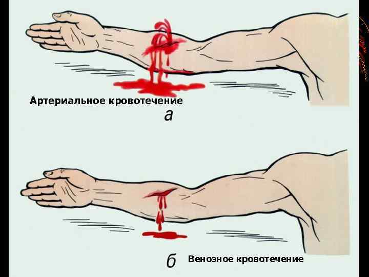 Артериальное кровотечение Венозное кровотечение 