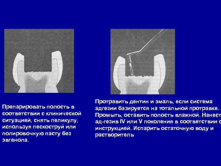 Препарировать полость в соответствии с клинической ситуацией, снять пеликулу, используя пескоструй или полировочную пасту