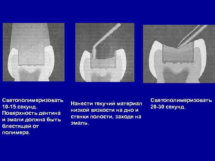 Светополимеризовать 10 -15 секунд. Поверхность дентина и эмали должна быть блестящей от полимера. Нанести