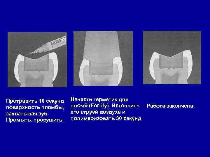 Протравить 10 секунд поверхность пломбы, захватывая зуб. Промыть, просушить. Нанести герметик для пломб (Fortify).