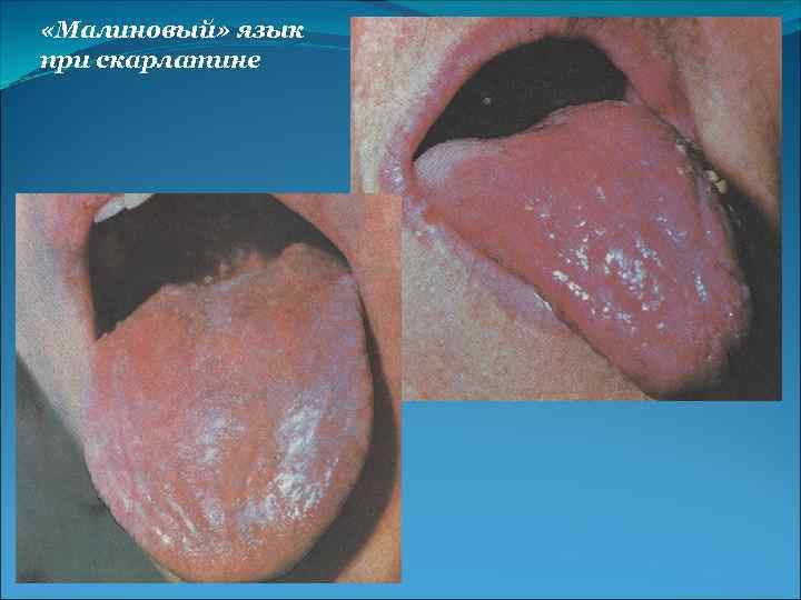  «Малиновый» язык при скарлатине 