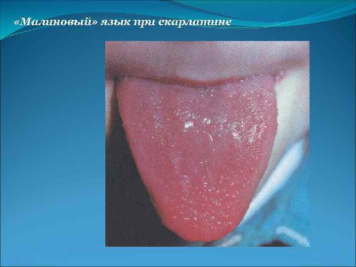  «Малиновый» язык при скарлатине 