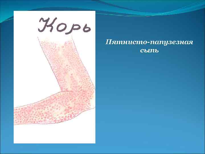 Пятнисто-папузезная сыпь 