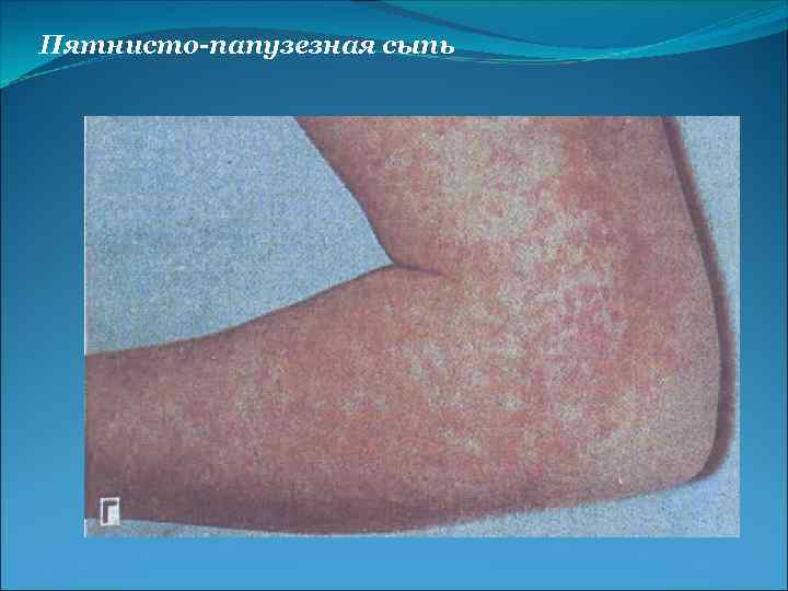 Пятнисто-папузезная сыпь 