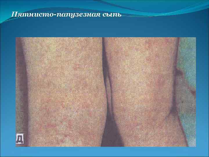 Пятнисто-папузезная сыпь 