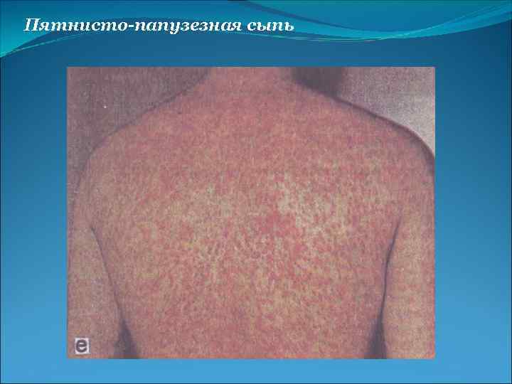 Пятнисто-папузезная сыпь 