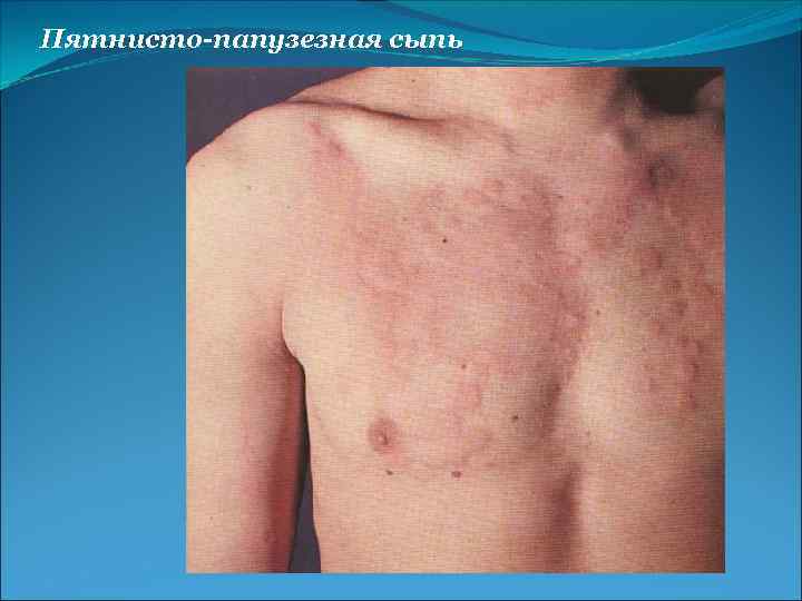 Пятнисто-папузезная сыпь 