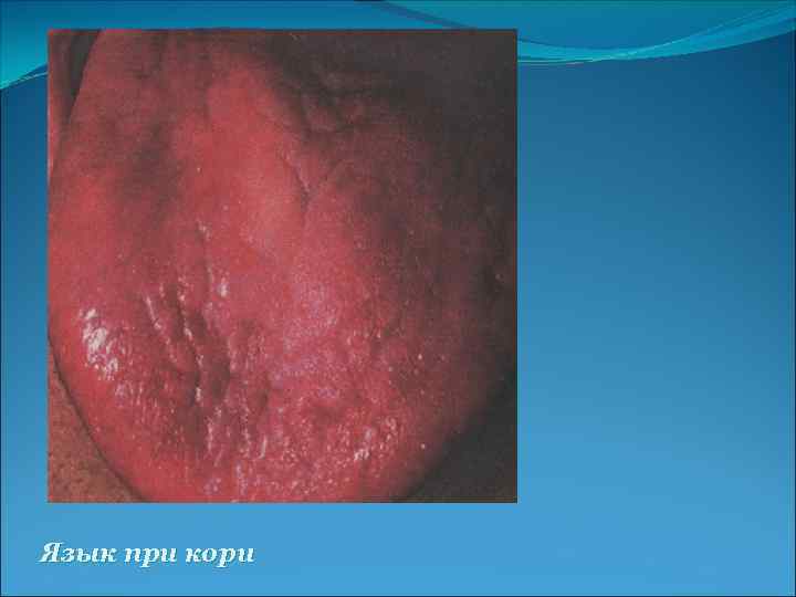 Язык при кори 