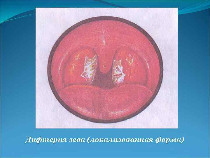Дифтерия зева (локализованная форма) 