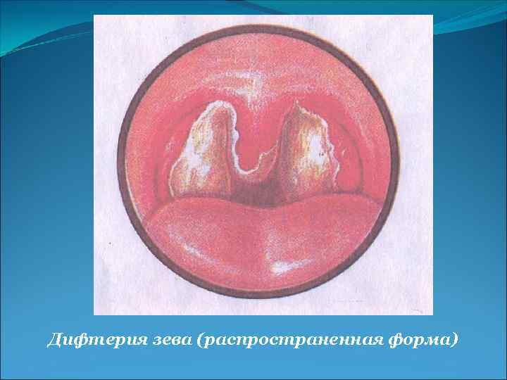 Дифтерия зева (распространенная форма) 