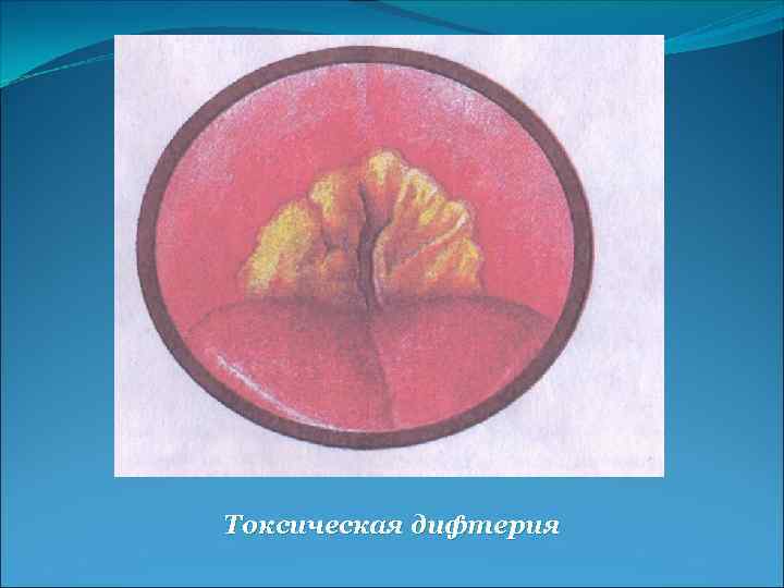 Токсическая дифтерия 