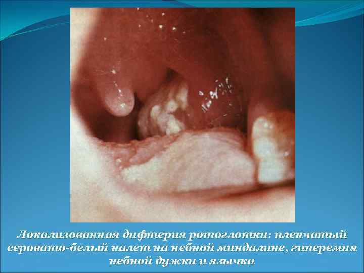 Локализованная дифтерия ротоглотки: пленчатый серовато-белый налет на небной миндалине, гиперемия небной дужки и язычка