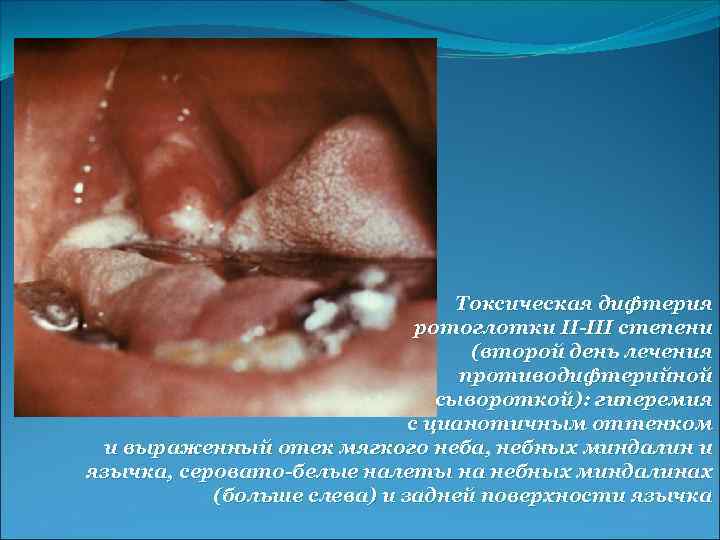 Токсическая дифтерия ротоглотки II-III степени (второй день лечения противодифтерийной сывороткой): гиперемия с цианотичным оттенком