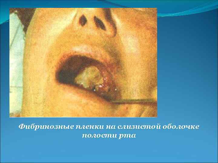 Фибринозные пленки на слизистой оболочке полости рта 