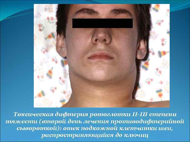 Токсическая дифтерия ротоглотки II-III степени тяжести (второй день лечения противодифтерийной сывороткой): отек подкожной клетчатки
