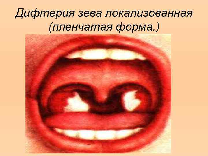 Дифтерия зева локализованная (пленчатая форма. ) 