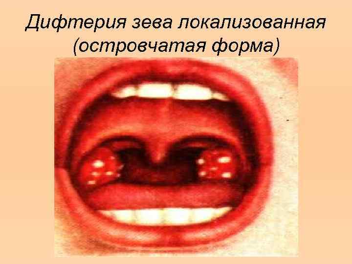 Дифтерия зева локализованная (островчатая форма) 