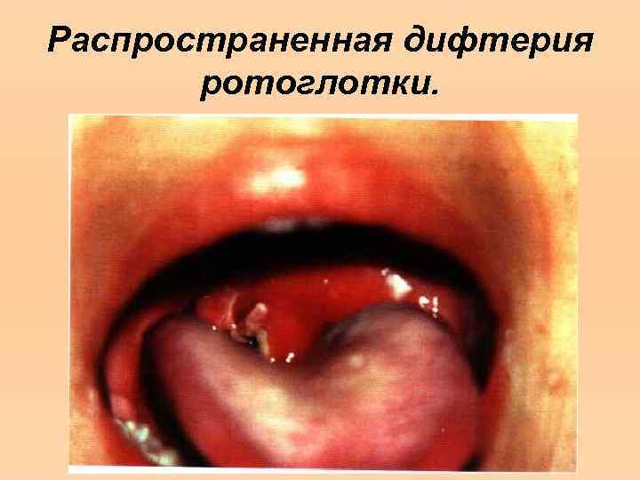 Распространенная дифтерия ротоглотки. 