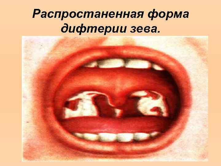 Распростаненная форма дифтерии зева. 